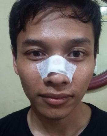 Ricuh di Sidang Pleno, Peserta Kongres HMI Asal Jakarta Terluka