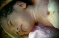 Bayi pertama dari buruh di Bengkalis ini lahir dengan usus dan lambung diluar