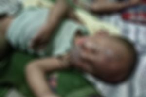 Mohon Bantuan! Balita Satu Tahun Korban Luka Bakar Kekurangan Biaya Pengobatan