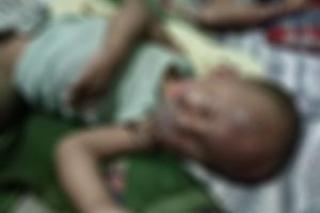 Mohon Bantuan! Balita Satu Tahun Korban Luka Bakar Kekurangan Biaya Pengobatan